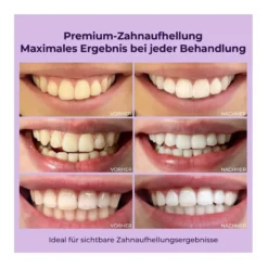 OnlySmile Zahnaufhellungsset (Starterkit), 1 St